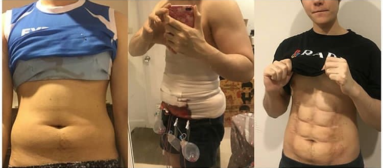 Pria yang melakukan operasi six pack. (Foto: istimewa)