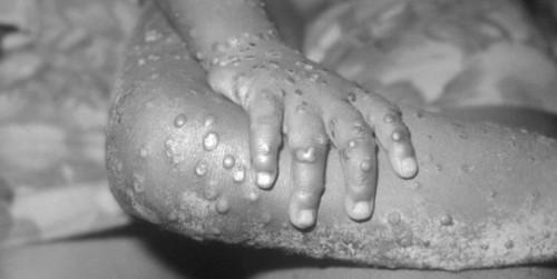 Cacar Monyet. ©CDC's Public Health Image Library