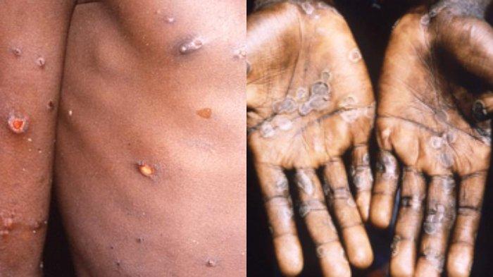 Penyakit cacar monyet atau monkeypox. (Foto istimewa)