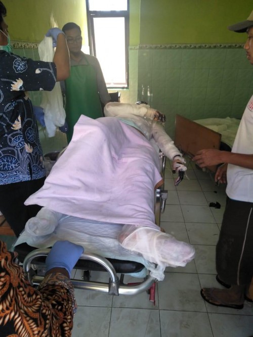 Anton korban kebakaran yang mengalami luka bakar hingga 75 persen saat mendapatkan perawatan di RSSA Kota Malang (Foto : Polsek Turen for MalangTIMES)