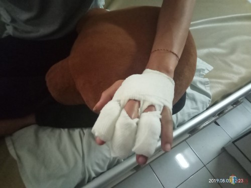 Jari tangan korban yang sempat dipukul dengan palu hingga harus menjalani operasi. (Anggara Sudiongko/MalangTIMES)