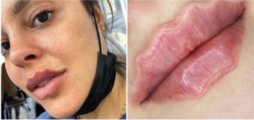 Filler bibir gelombang. (Foto: istimewa)