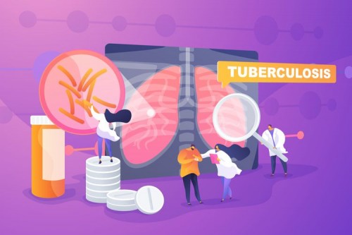 Ilustrasi TBC. (Foto: Shutterstock).