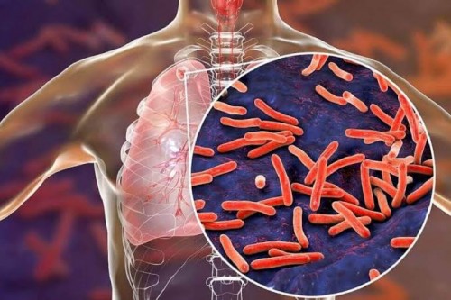 Ilustrasi serangan bakteri Mycobacterium Tuberculosis. (Ist)