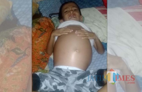 Kondisi perut Yakin Wandika yang menderita Tumor, tidak lama lagi akan menjalani operasi (foto : diskominfo / Jatim TIMES)