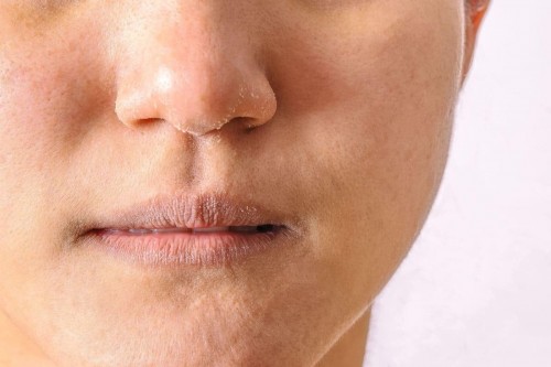 Ilustrasi kulit kering. (Foto: www.womenshealthmag.com)