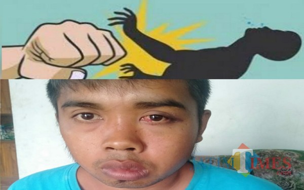 Kondisi wajah DD yang mengaku jadi korban penganiayaan / Foto : Sobar / Tulungagung TIMES
