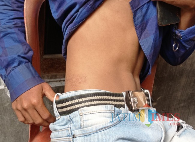 Luka pada bagian perut Iqbal saat keluar dan tergoser tembok (foto: Hendra Saputra/JatimTIMES) 