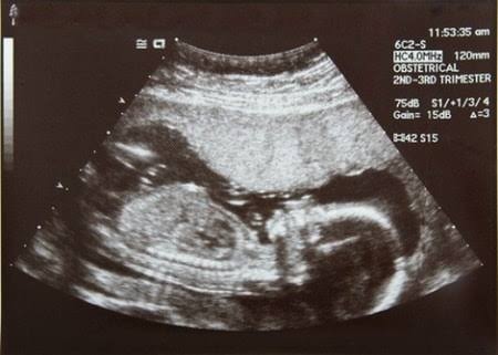 Jenis Kelamin Bayi